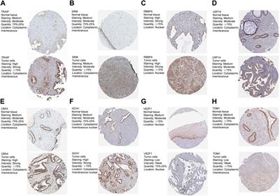 Construction of a prognostic model based on eight ubiquitination-related genes via machine learning and potential therapeutics analysis for cervical cancer